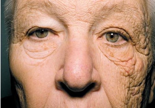 The Role of Sun Exposure in Skin Ageing